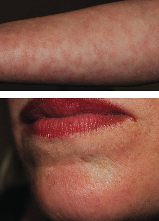 What is the cause of this rash on this woman’s arms? Consultant360